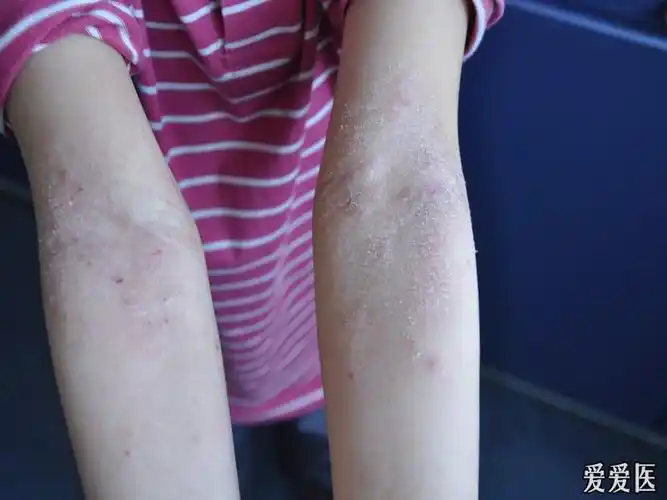 干性湿疹儿童求助(有图),请群里高人指点,在此谢过