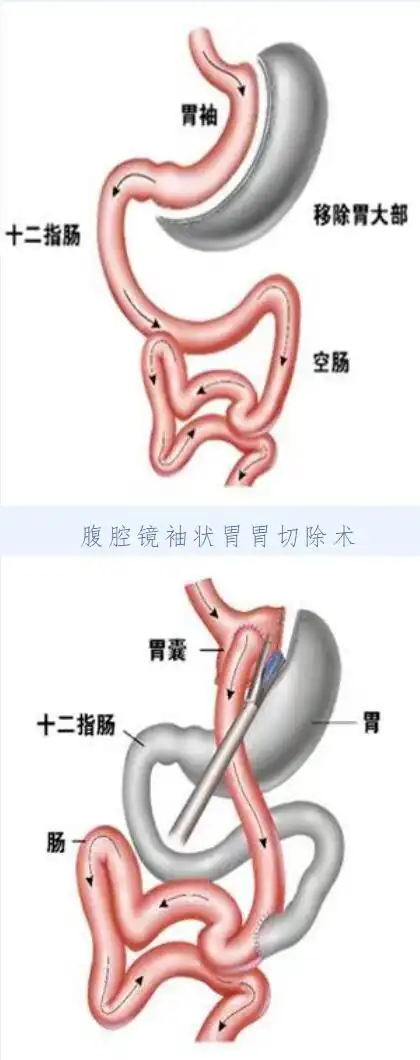 腹腔镜roux-en-y胃旁路术我院普外科开展减重手术一年来,已有六位"胖