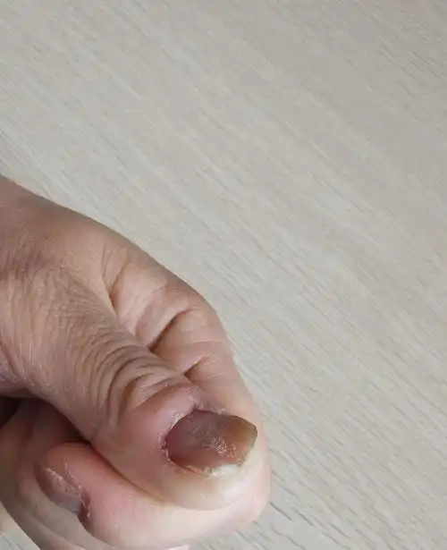 求助指甲凹陷十几年都长不平是什么原因? - 知乎