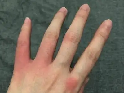 皮肤蝇蛆病的症状和图片 - 有来医生