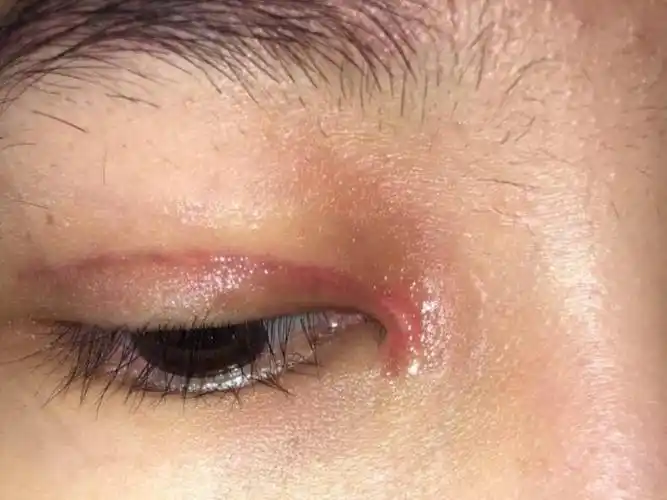 双眼皮疤痕双眼皮术后1-3个月属于疤痕增生期,切_圈子-新氧美容招形