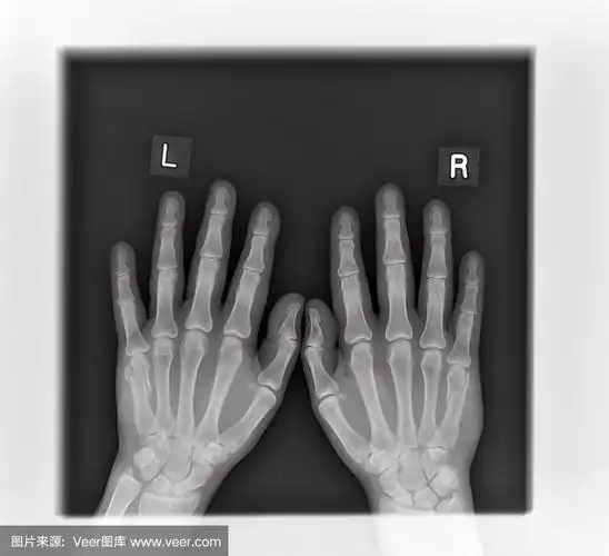 手部x光片,掌骨骨折