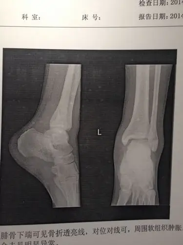 左脚踝骨折,不知怎么治疗?