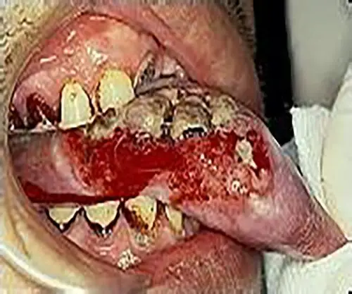 舌癌的晚期症状图片