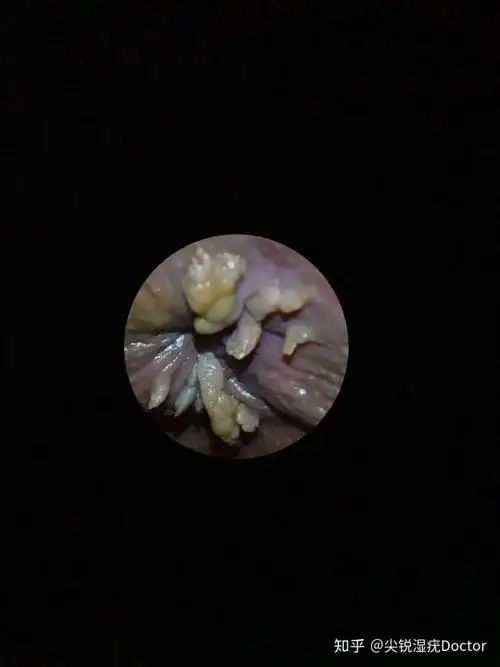 尖锐湿疣,肛周疣体症状图片