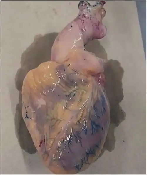 在 75 岁以上的人中,大约 5% 患有心肌梗死,但很少或没有病史症状