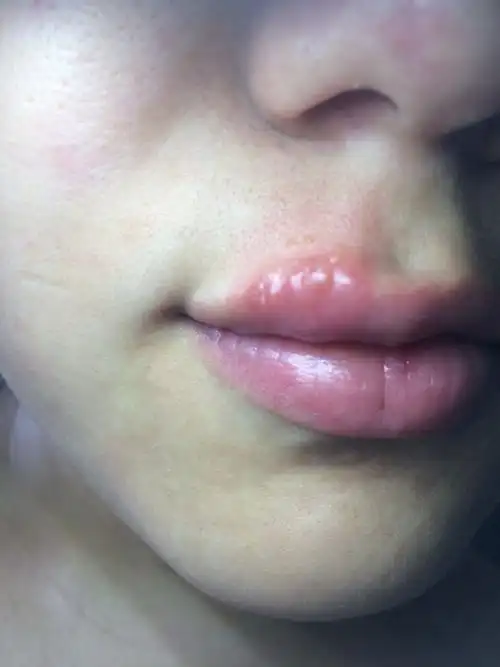 嘴上长了个水泡,有点痒又有点疼,该怎么办呢