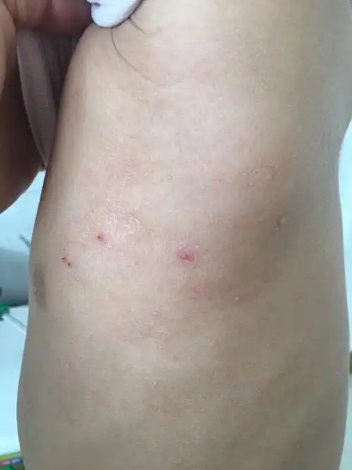 请问孩子身上长的这个疣怎么去除,孩子3岁太小了,没办法激光