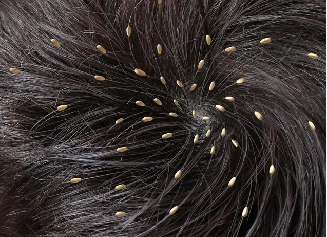 为什么过去困扰农村人的虱子,如今也少见了?原因其实很简单!