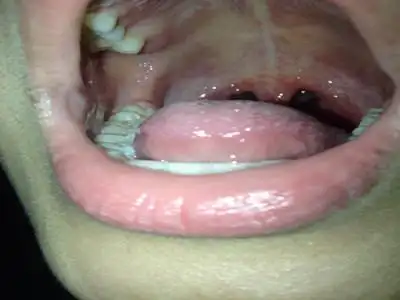 小学生白喉怎么办