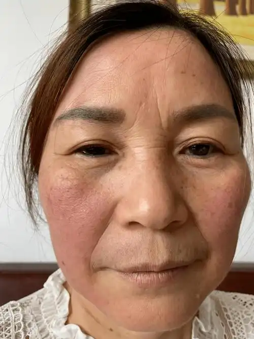 做了色素管理之后, 直接从" 黄脸婆 "变小姐姐真人实拍,店主的妈妈,60