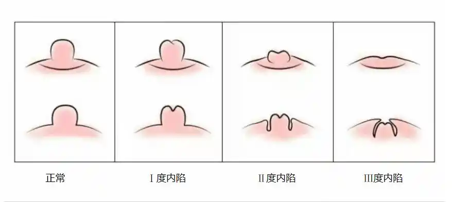 乳头内陷是怎么回事与乳腺癌有关吗