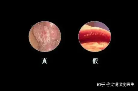 怎么区分尖锐湿疣还是珍珠疹