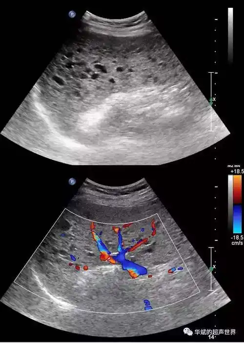 脾大能自己恢复吗?