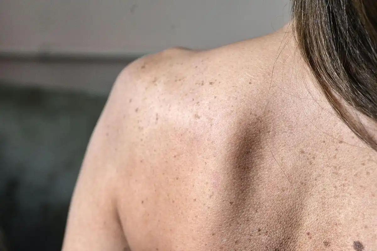 60岁的女人后背长了一块块白斑 #老人# #长斑# #白癜风#    60岁的