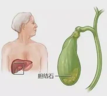 胆结石也是一种悄无声息的疾病所以这些身体信号要注意