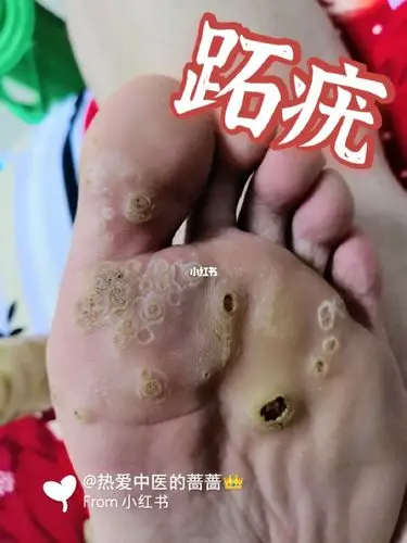 跖疣小伙伴不用再忧愁了93_中药_中医_修脚_药膏_修脚跖疣鸡眼_医疗