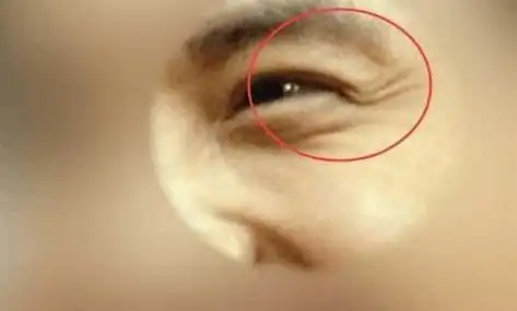 此处所说的鱼尾纹多是指,男人还年轻时眼角的鱼尾纹就多.