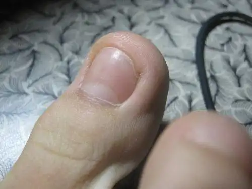 我脚趾头的指甲太短咋办