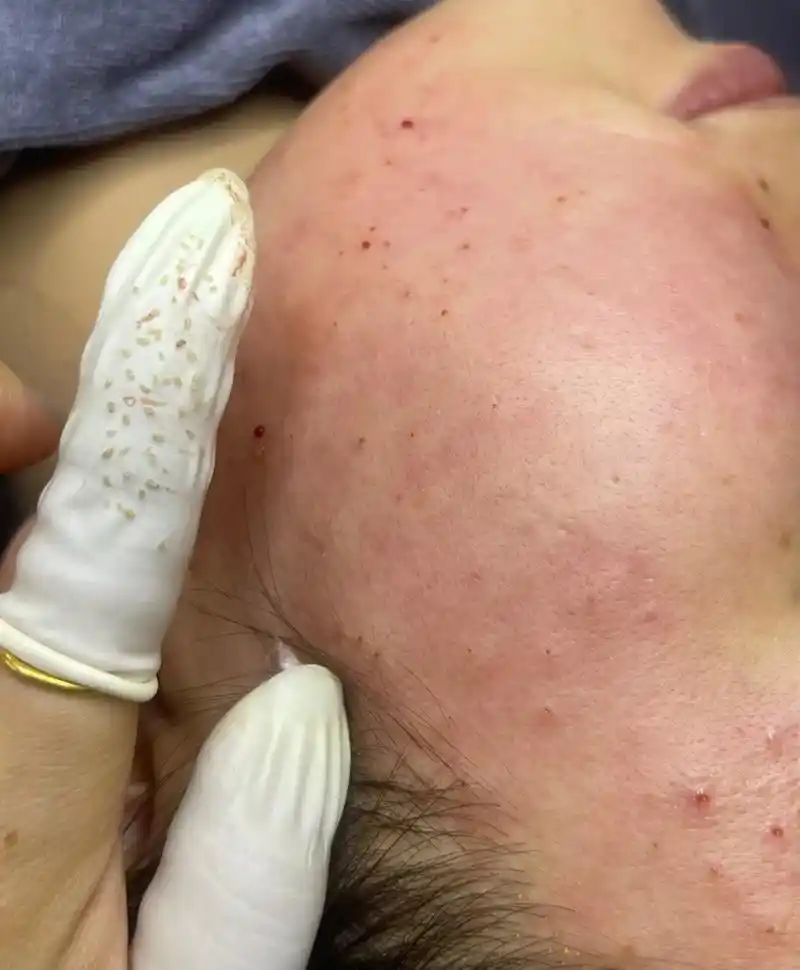 痘痘黑头粉刺拜拜 #解决任何皮肤问题 #只要青春不要痘 山 - 抖音