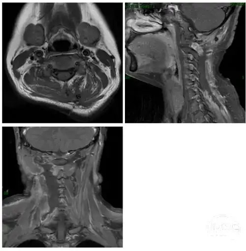 中国医学科学院肿瘤医院万经海教授头颈部韧带样纤维瘤一例