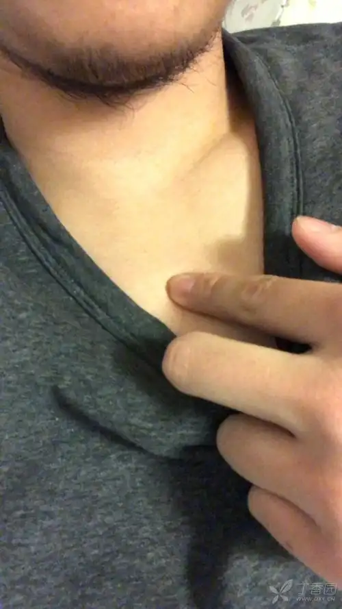 胸骨柄皮下疙瘩