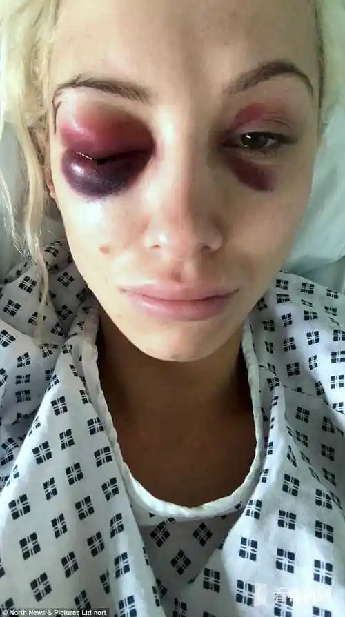 模特被软禁打成熊猫眼脑出血 偷偷发自拍获救