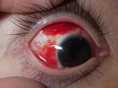 眼睛里有红血丝,磨着疼,早晨有眼屎,是不是结膜炎呢_流行性出血性结膜