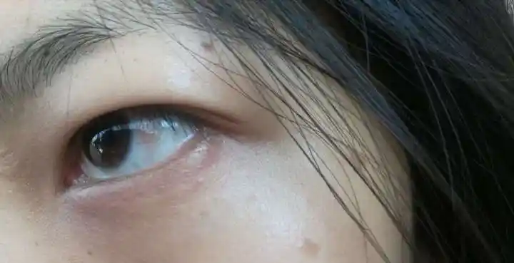 非常常见的睑裂斑