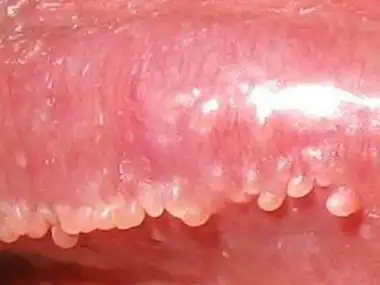 阴茎珍珠样丘疹病