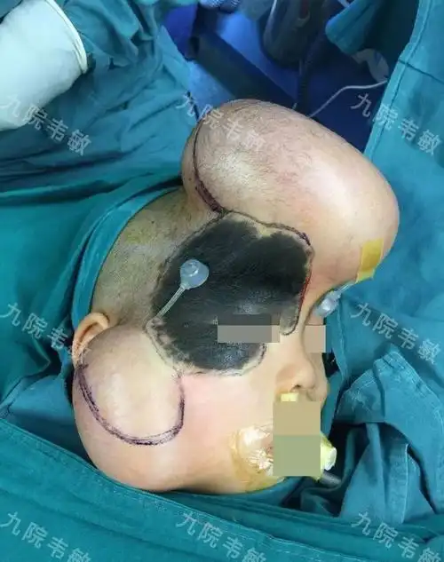 2岁黑毛痣男儿扩张器皮瓣修复成功除痣记录