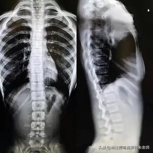 在身体前屈时我还是能够明显看到后背的不平衡隆起,而且腰椎曲度反弓