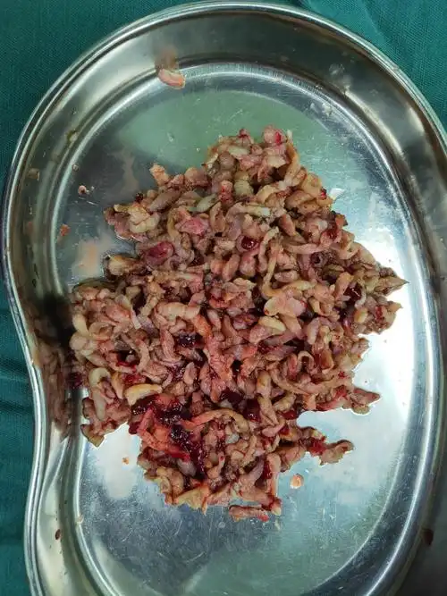 切除的前列腺增生腺体.