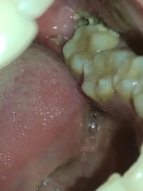 牙龈肿痛脸部肿怎么办 牙龈肿痛引起的脸肿怎么办