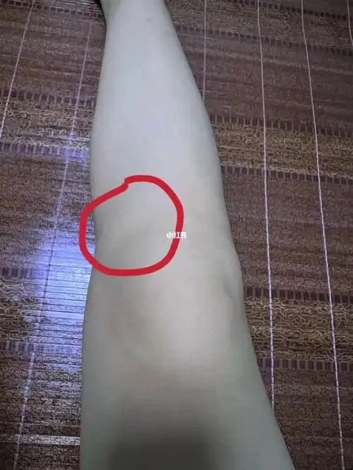 小红书助手  膝盖内侧标注的地方很痛,去医院看了,医生说韧带拉伤贴
