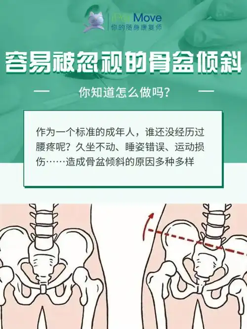 容易被忽视的骨盆倾斜,你注意了吗?