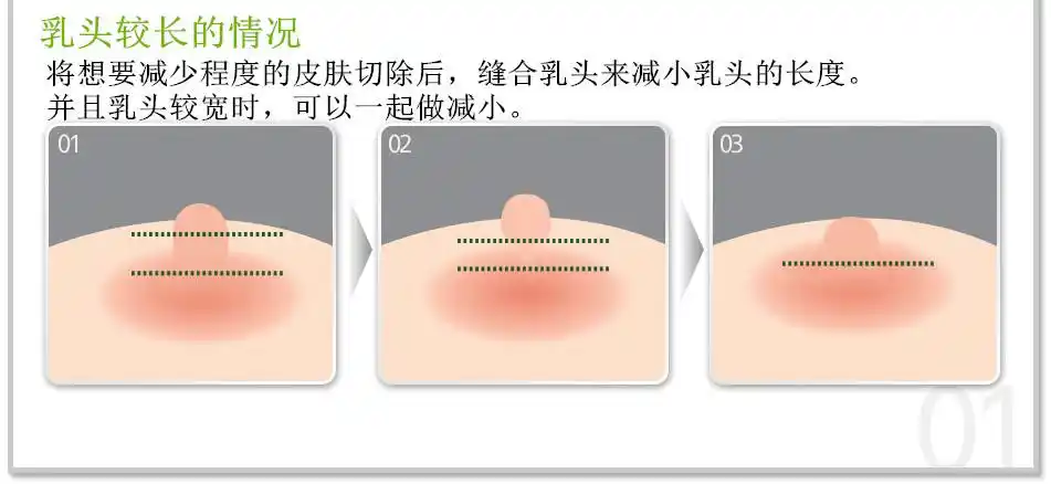 上海美莱陈斌乳头内陷可以通过整形矫正吗