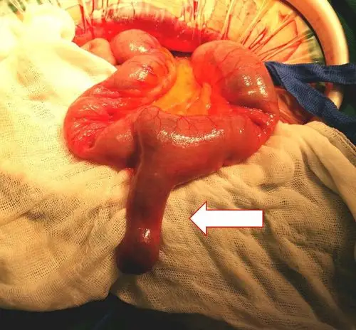 什么是憩室炎(图)_肠疾病_肠疾病相关疾病 - 好大夫在线