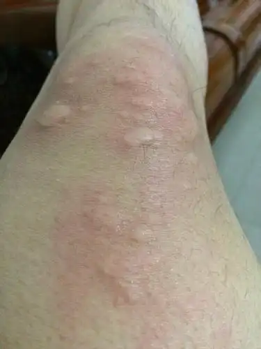 请问这是什么过敏,是螨虫吗.现在变成一大块红红的.