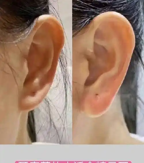 面相学的人来说是比较希望改善的,并且耳廓薄的话支撑性也不强,耳朵软