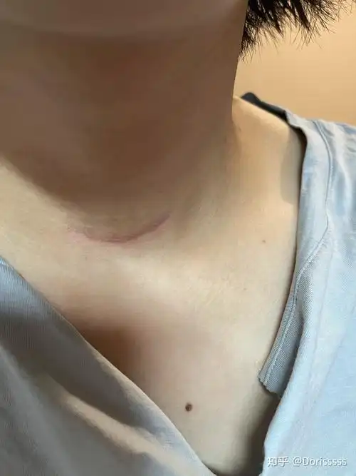 日2021年3月8日甲状腺全切手术,5月17日131的,疤痕真是不断变化中成长