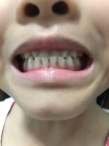 小朋友5周岁,有地包天,居住深圳,小朋友矫正牙齿能不能走医保卡?