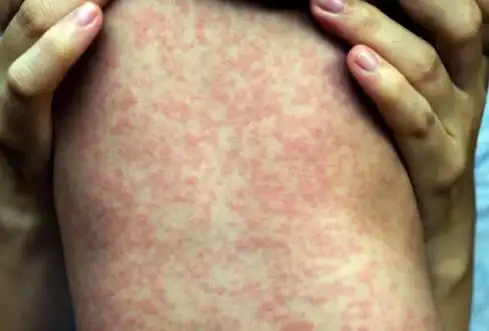 麻疹风疹猩红热有什么不同麻疹风疹猩红热的区别