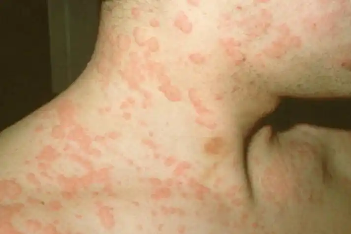 药物性狼疮患者的侧颈上可出现大小不一的盘状红斑狼疮,蝶形红斑,数量