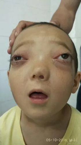 看到一个双眼球突出患儿,请各位老师指教