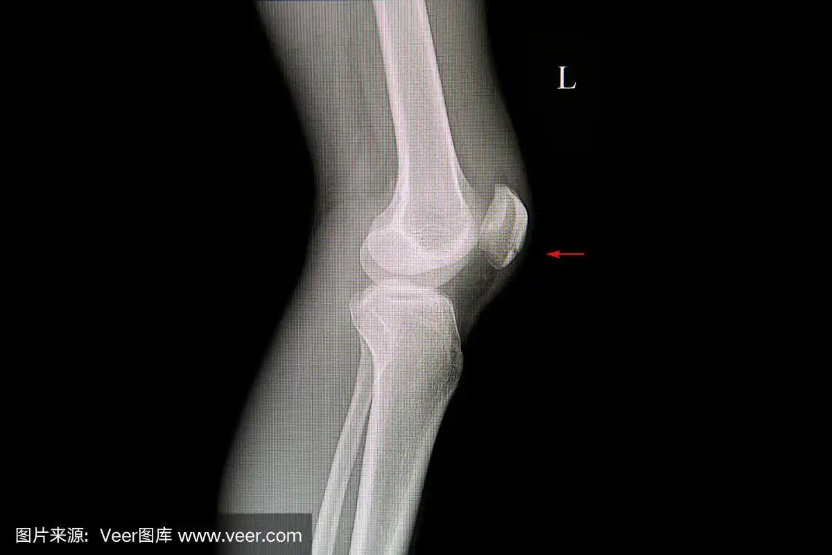 髌骨骨折病人的x光片