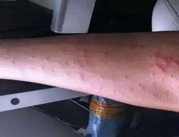丘疹性荨麻疹的发病症状图片