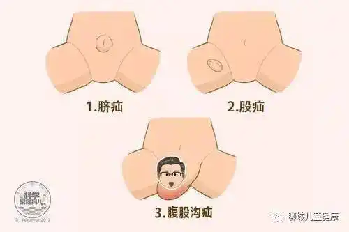 腹股沟疝分为腹股沟斜疝和直疝,斜疝较常见,直疝罕见.