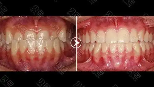 地包天矫正前后