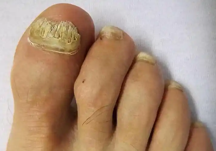 灰指甲反复难根治?教你一个低成本居家疗法,灰甲秒变健康新甲!